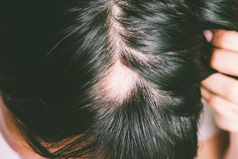 The Role of Vitamins and Minerals in Hair Loss